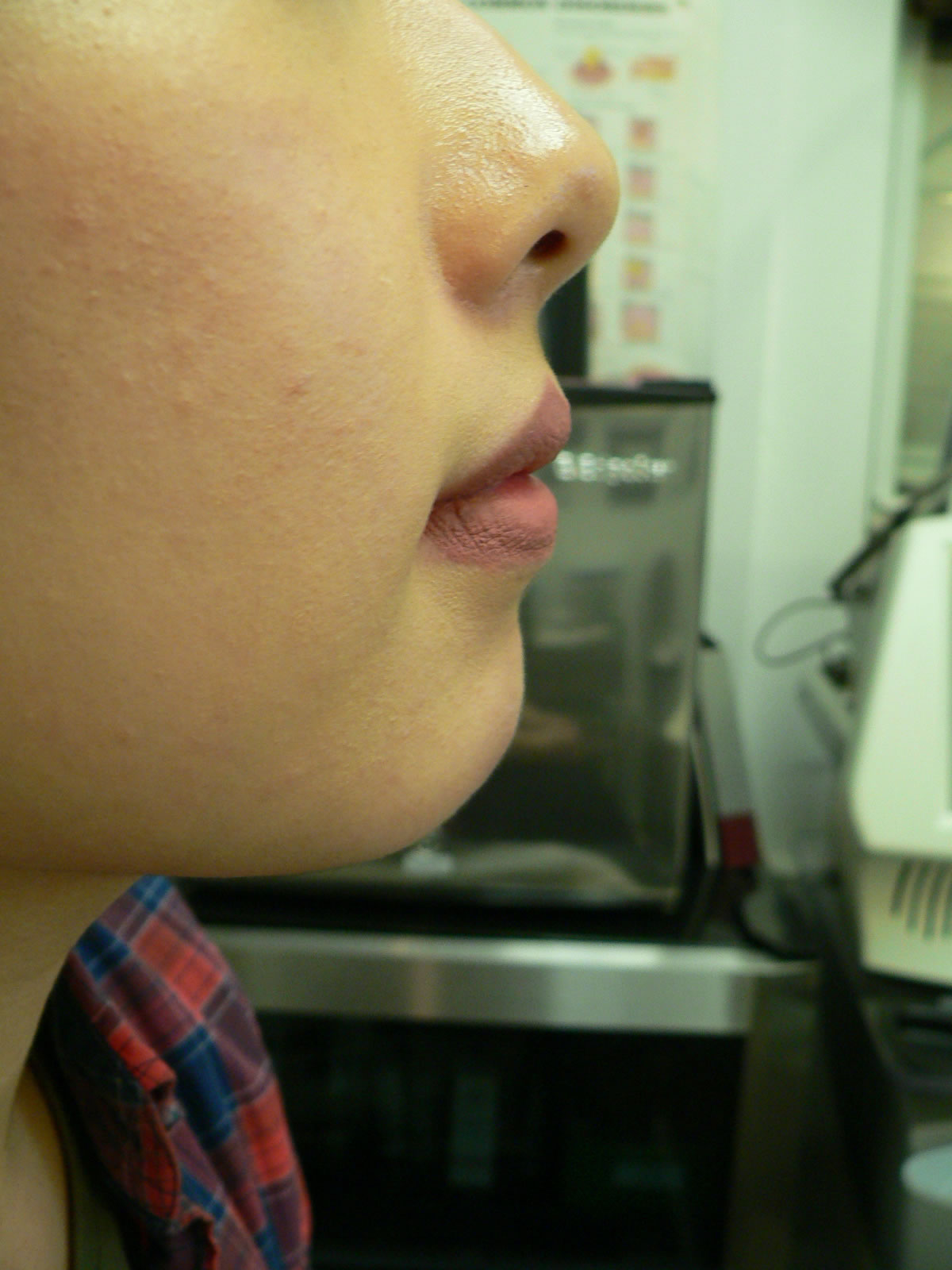 chin_enhancement_nyc